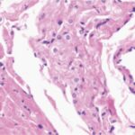 Sinus node (unexposed)