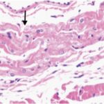 Sinus node (exposed, day 1)