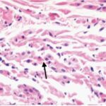 Sinus node (exposed, day 14)